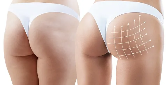 Best Doctors in Dubai for Butt Fat Transfer: What to Expect from the Procedure