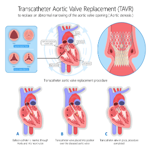 Transcatheter Aortic Valve Replacement