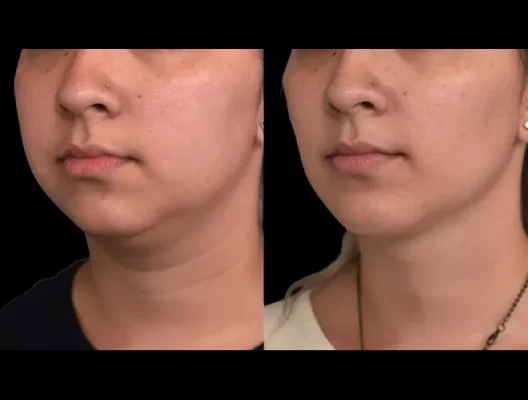 Double chin removal