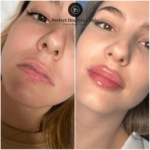 Dermal Fillers