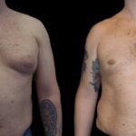 gynecomastia in dubai