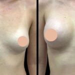 Breast Augmentation in Dubai: Understanding the Different Types of Procedures