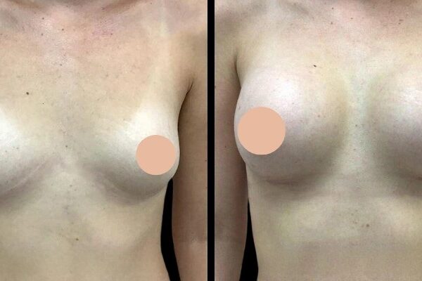 Breast Augmentation in Dubai: Understanding the Different Types of Procedures