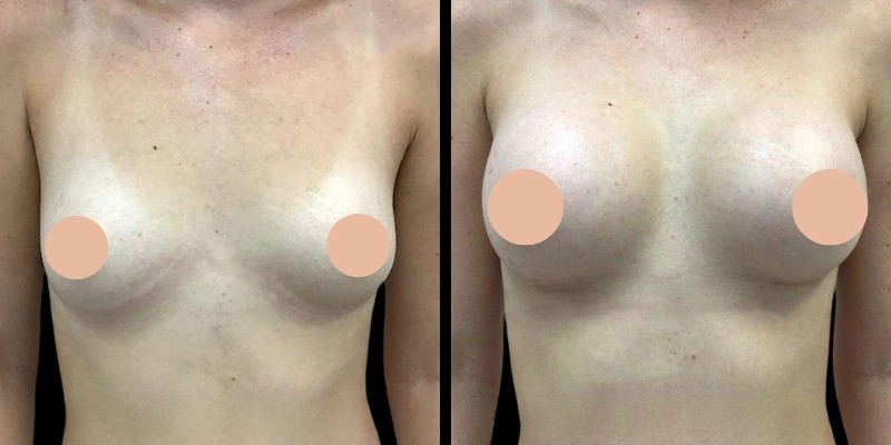 Breast Augmentation in Dubai: Understanding the Different Types of Procedures