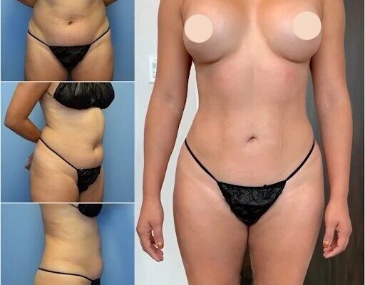 Body Contouring Surgery in dubai