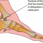 fractures and dislocations