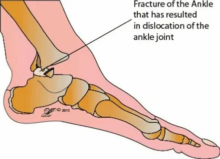 fractures and dislocations