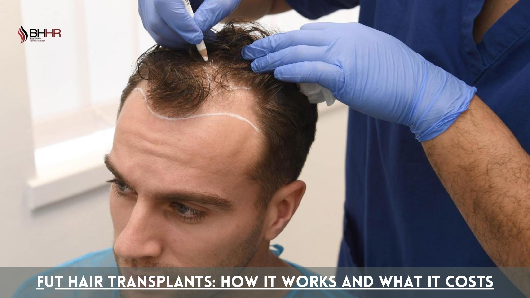 fut hair transplant