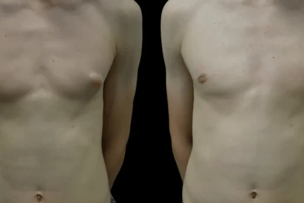 Best Gynecomastia Surgeon in Dubai