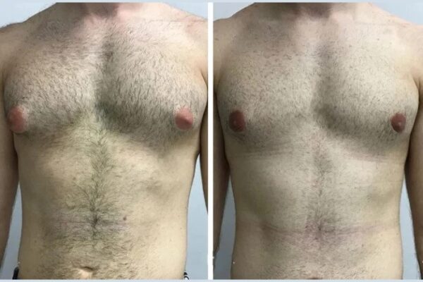 Best Doctors in Dubai for Gynecomastia