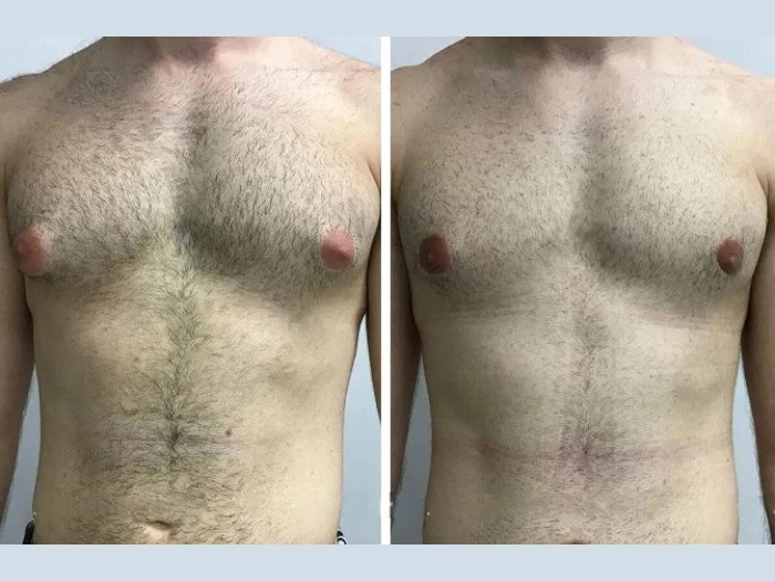 Best Doctors in Dubai for Gynecomastia