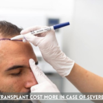 hair transplant cost