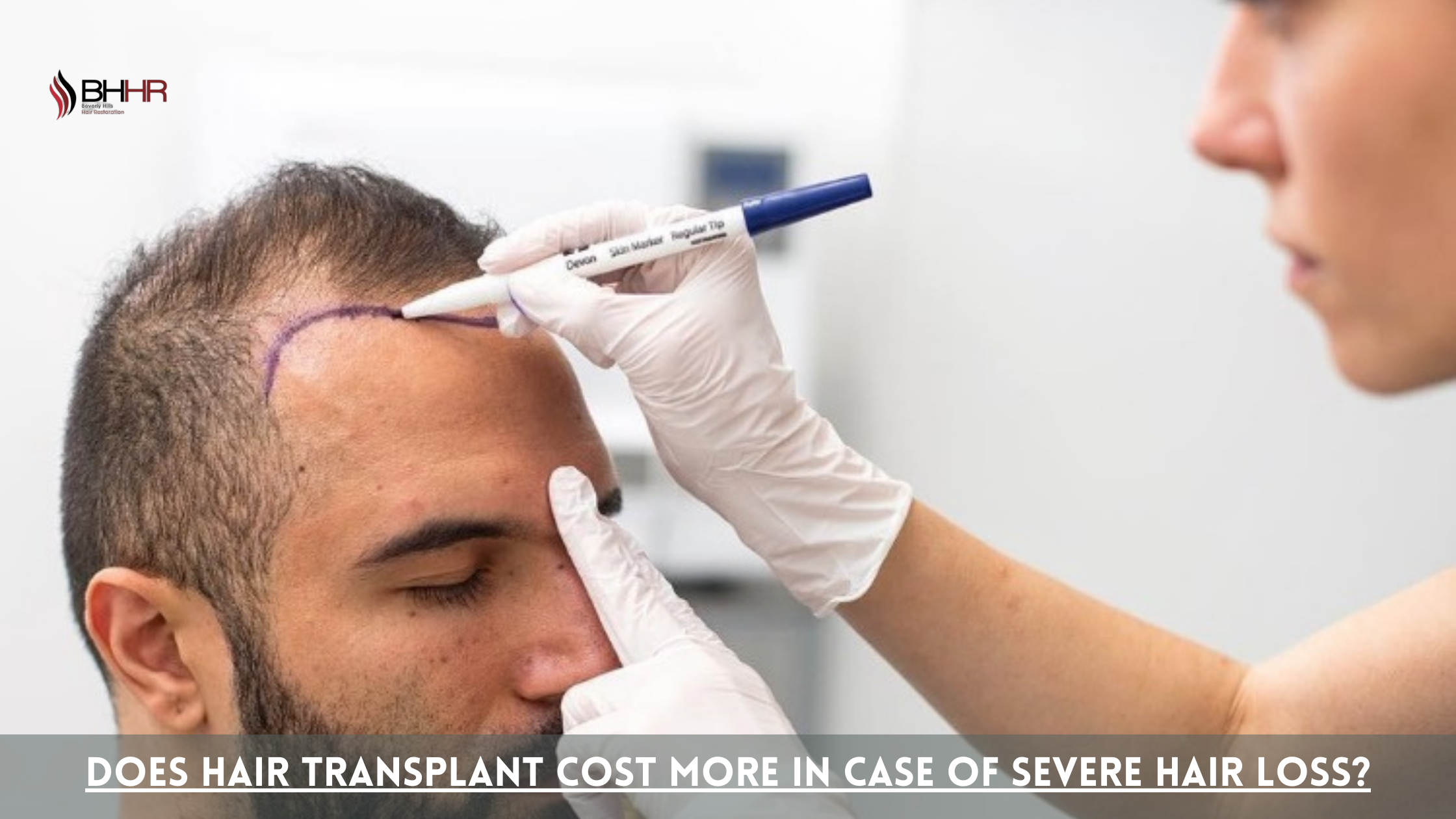 hair transplant cost