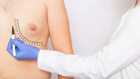 gynecomastia