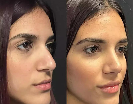 How the Best Rhinoplasty Surgeon in Dubai Ensures a Safe and Successful Procedure