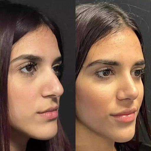 How the Best Rhinoplasty Surgeon in Dubai Ensures a Safe and Successful Procedure