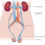 varicocele embolisation