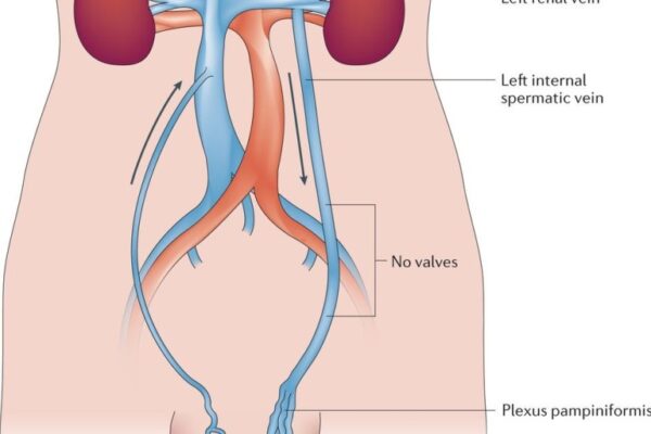 varicocele embolisation