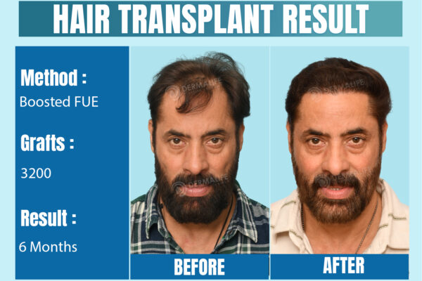 Hair Transplants