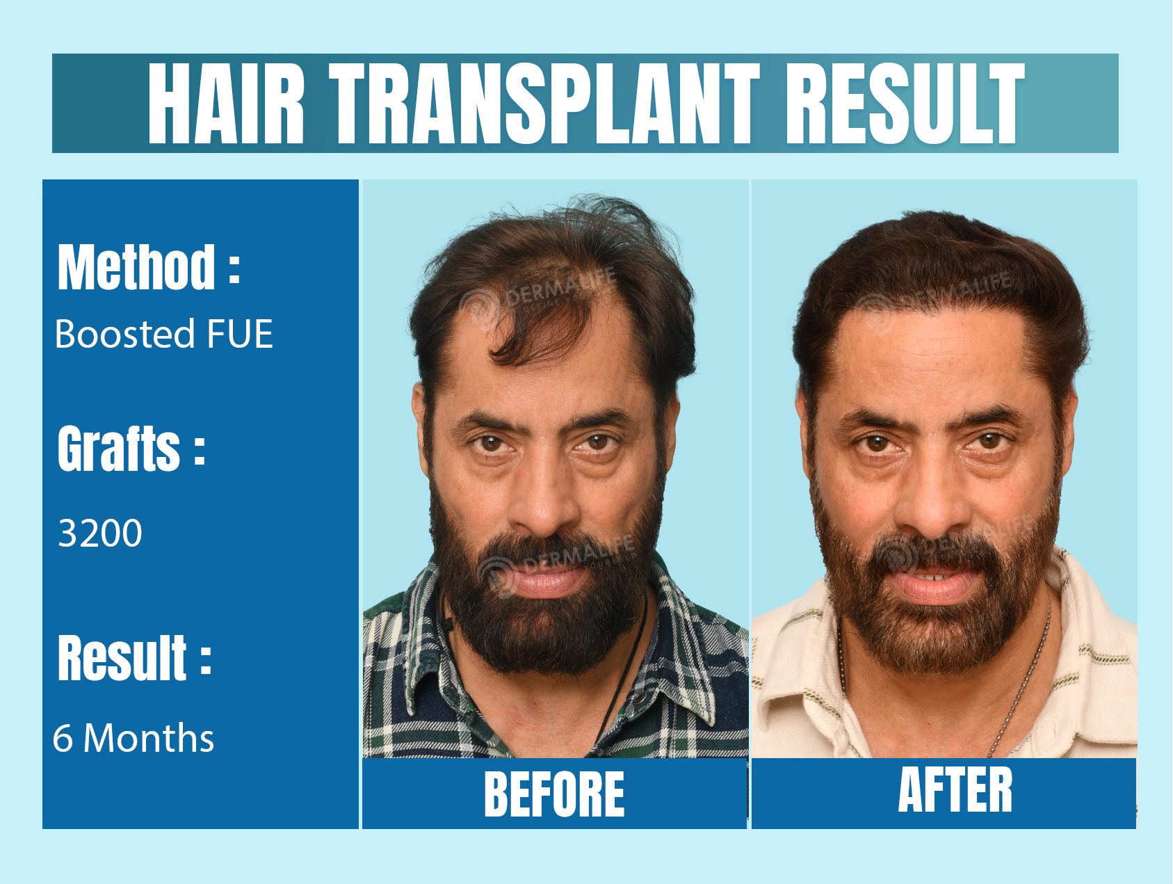 Hair Transplants