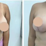 breast lift in dubai