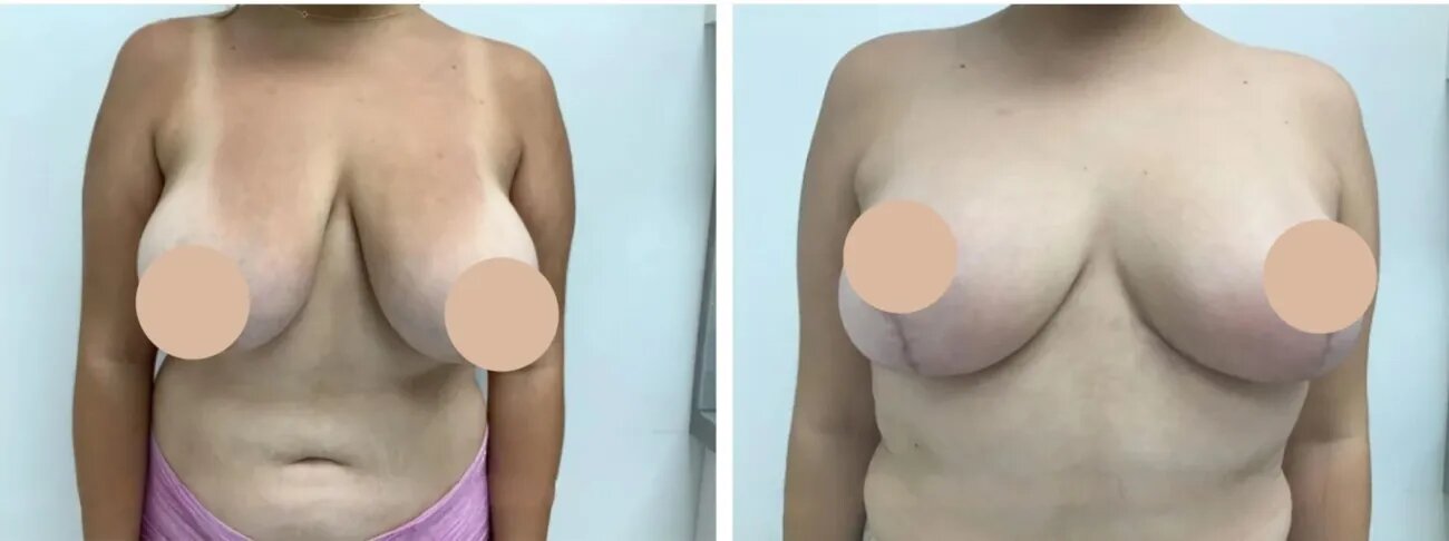 breast lift in dubai